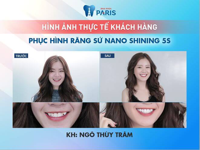 Hình ảnh khách hàng thực hiện dịch vụ bọc răng sứ tại Nha khoa Paris