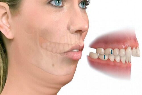 Thực hư 4 cách chữa răng vẩu tại nhà được nhiều người truyền tai nhau
