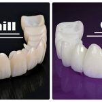 Nên bọc răng sứ Ceramill hay răng sứ Cercon?