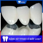Răng sứ titan có mấy loại? Dùng loại nào là Tốt Nhất?